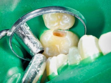 Karies ja - nein. Foto Dr. med. dent. Karl-Uwe Jülich, Bergneustadt