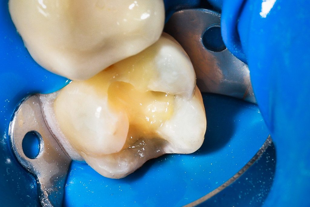Zahn wird für die Bioclear-Methode vorbereitet — Bioclear-Methode. © Dr. med. dent. Karl-Uwe Jülich, Bergneustadt