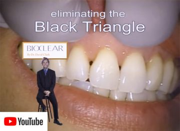 Preview YouTube Film Bioclear: eleminating the Black Triangle