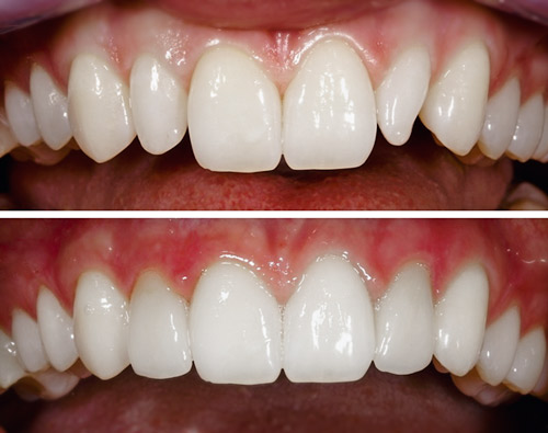 Formveränderung (Diminutivform) der seitlichen Schneidezähne. Zahnarzt Dr. Jülich Bergneustadt