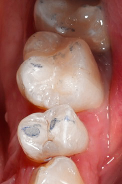 Abriebstellen an den Zähnen eines Knirschers. Zahnarzt Dr. Jülich Bergneustadt