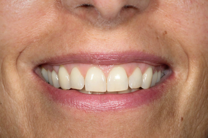 Patientin in den 40gern mit schönen natürlichen Zähnen