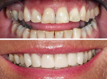 Korrektur mit Veneers - Zahnarzt Dr. Jülich, Bergneustadt