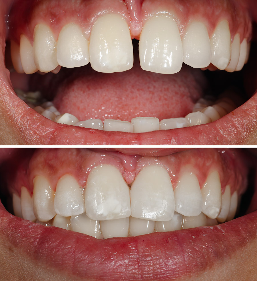 Zahnlücke mit Bioclear geschlossen, vorher - nachher. Foto Dr. Jülich